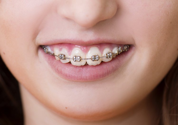 Orthodontic braces for children